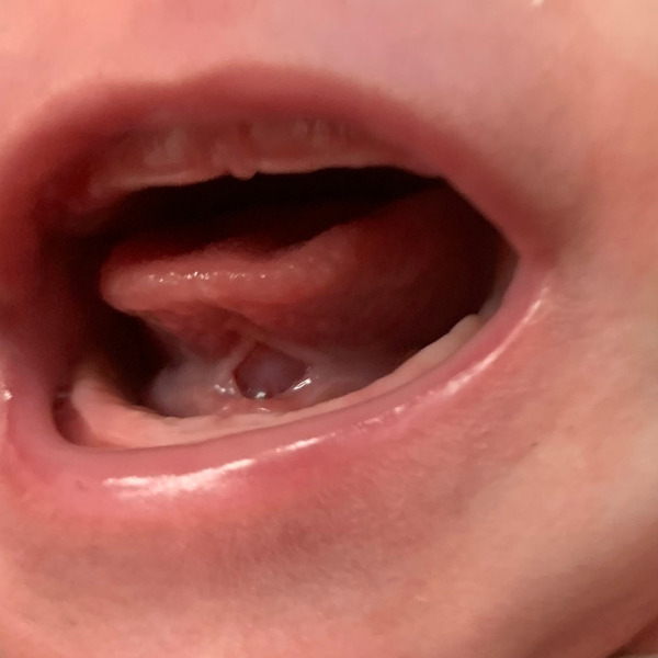 anquiloglosia